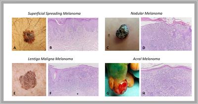 Cutaneous Melanoma Classification: The Importance of High-Throughput Genomic Technologies